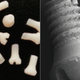 Image for article titled Someday, Surgeons Might Fix Your Broken Bones With Screws Made of Silk